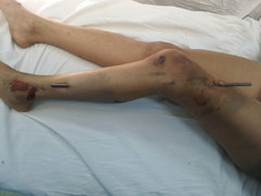 Những ca bệnh khó tin nhất năm 2017: Người chết bỗng thức dậy, 100 khối u giày vò, bào thai lạc lên lá lách