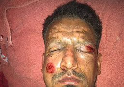 Đốt pháo hoa mừng Giáng Sinh, cầu thủ bị tai nạn biến dạng khuôn mặt