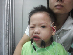 Trời lạnh, nhiều trẻ em bị méo miệng, lệch mặt