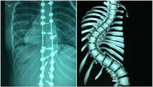 Thiếu nữ cao thêm 7 cm sau khi nắn cột sống từ vẹo thành thẳng