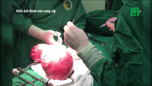 Cô gái mang khối u 4 kg trong bụng mà không biết