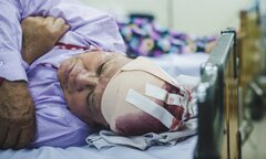 Mổ lấy được cục máu đông gây đột quỵ dài gần 10cm