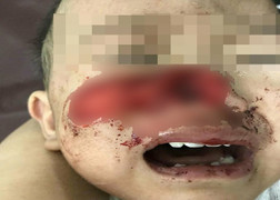 Xót xa bé trai 1 tuổi bị chó nhà cắn rách mặt, mất mũi