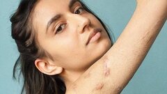 10 cô gái dũng cảm và câu chuyện vết sẹo đi theo cả cuộc đời