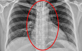 Gái mại dâm nuốt bao cao su để thủ tiêu bằng chứng