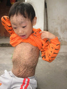 Xót xa bé trai mắc bệnh vảy cá bẩm sinh, toàn thân sần sùi, nứt nẻ