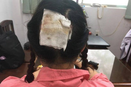 Uốn tóc đón Tết, người phụ nữ bị hoại tử da đầu vĩnh viễn, không thể phục hồi