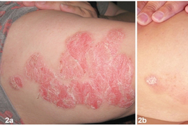 Hướng điều trị mới cho bệnh vảy nến