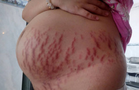 Tưởng chỉ rạn da, bà bầu tá hỏa khi bác sĩ thông báo bị ứ mật gan