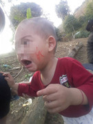 Xót xa bé trai bị cam miệng hoại tử lở loét, chảy máu khắp chân răng