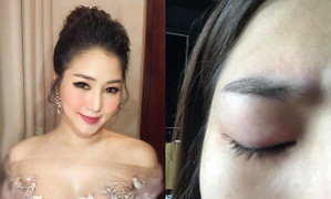 Hương Tràm gần như mất thị giác, di chuyển phải có người dìu đi