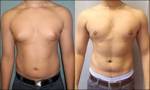 Bị hội chứng vú to, người đàn ông phải đi phẫu thuật thẩm mỹ