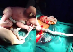 Video: Cận cảnh em bé bị dây rau thắt nút chào đời khỏe mạnh