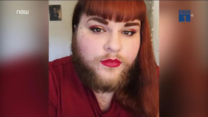 Tình yêu đẹp như mơ của cô gái có râu quai nón như đàn ông