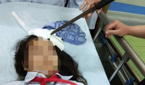 Nữ sinh bị bạn phi dao cắm thẳng vào trán