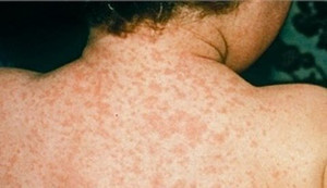 Cảnh báo bệnh sởi quay trở lại TP.HCM