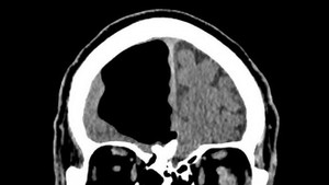 Đến viện khám chân, cụ ông choáng váng khi biết não mất một phần