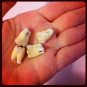 Video: Xem cận cảnh quá trình nhổ răng số 8