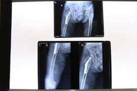 Ngã trong lúc đi vệ sinh, cụ bà 105 tuổi bị gãy mấu chuyển xương đùi phải