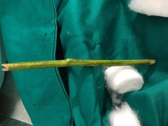 Chọc que nứa phá thai và những trường hợp phá thai kinh dị ở Việt Nam