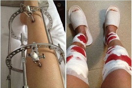 Ca phẫu thuật kéo dài chân kỷ lục ở Việt Nam