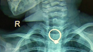 Ngủ quên, mẹ để con gái hóc nhẫn kim cương