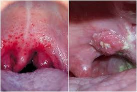 Hiểu nhầm về ung thư khiến bạn lãng phí tiền bạc và tuổi thọ