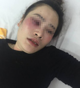 Tranh nhau đĩa bánh xèo, nam thanh niên đánh cô gái chảy máu mũi phải nhập viện