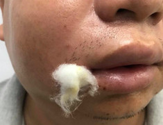 Cầu cứu bác sĩ sau 5 giờ cạy nốt mụn trên mặt