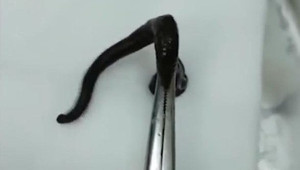 Clip: Gắp con đỉa dài 15 cm còn ngoe nguẩy ra khỏi mũi bé 9 tuổi