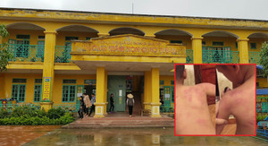 Bé trai 5 tuổi nghi bị giáo viên bạo hành dã man, phụ huynh không muốn làm to chuyện