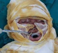 Xót thương bé gái 2 tuổi ngã vào nồi bỗng rượu bỏng nặng toàn thân