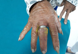 Suýt mất ngón tay vì đeo nhẫn quá chật