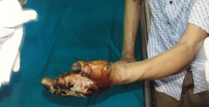 Da bong tróc, hoại tử bàn tay vì máy ép mía