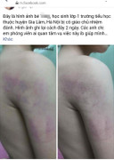 Nghi vấn học sinh lớp 1 Hà Nội bị cô giáo bạo hành thâm tím cánh tay