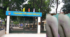 Học sinh lớp 1 bị cô giáo đánh bầm tím tay: Hiệu trưởng nói gì?
