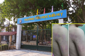Kỷ luật cảnh cáo cô giáo đánh bầm tím người học sinh lớp 1 ở Hà Nội