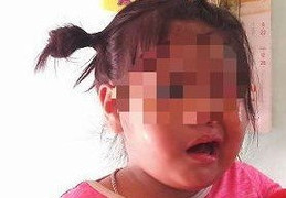 Nghi vấn cô giáo mầm non đánh bé 3 tuổi liệt dây thần kinh, méo mồm
