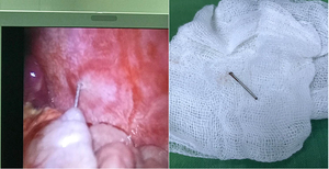 Thợ mộc nghịch dại, bé trai 15 tháng tuổi bị súng bắn đinh găm vào người