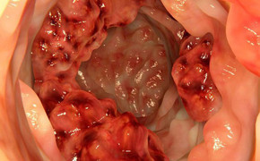 7 dấu hiệu ung thư đại trực tràng rất nhiều người chủ quan bỏ qua