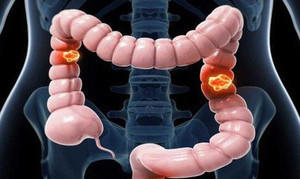 8 người trong một gia đình Tuyên Quang bị ung thư đại tràng