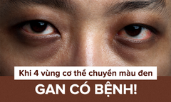 Khi 4 bộ phận cơ thể chuyển màu đen: Hãy thận trọng dấu hiệu bệnh gan đang phát triển