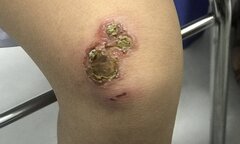 Cảnh giác con bạn dễ nhiễm trùng da, lở loét hơn trong mùa hè