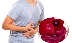 Ăn bún, phở, dưa chua, thực phẩm bị mốc có thể khiến bạn mắc ung thư gì?