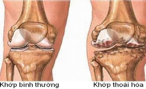 Bài thuốc Nam ‘đánh bật’ thoái hóa khớp tận gốc