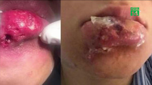 Video: Tiêm filler làm đẹp, hoại tử mũi, môi, mặt biến dạng khủng khiếp