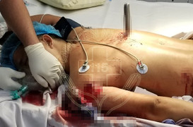 Bệnh viện bật 'báo động đỏ' cứu người đàn ông bị dao đâm xuyên ngực