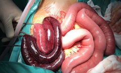 2 ngày không đi đại tiện, cụ ông bị hoại tử 1 m ruột