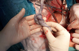 Một giờ căng thẳng mổ cứu thai nhi có dây rốn thắt nút trong bụng mẹ