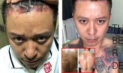 Căn bệnh khiến ca sỹ Tuấn Hưng 'phát điên' khó chữa tới mức nào?